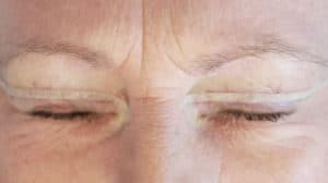 Streifenplaster auf dem Augenlid nach einer Lidkorrektur