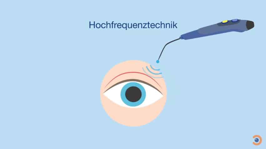 Lidkorrektur mit HF Hochfrequenztechnik