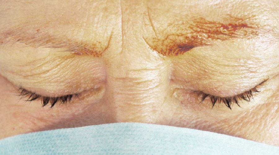 Augenlidstraffung Vorher Nachher Bilder Lidkorrektur München
